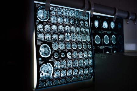 Problema cerebral oculto pode ser sinal precoce de Alzheimer brain MRI scan Alzheimer