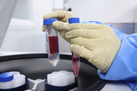 Desajuste en análisis de sangre alerta riesgo renal y de muerte kidney blood test