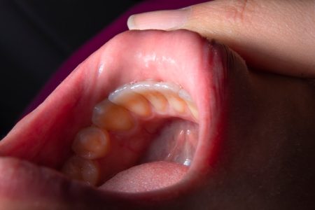 Bactérias bucais podem desencadear a doença de Parkinson mouth bacteria Parkinson's disease